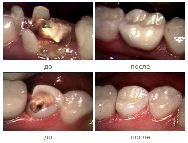 Восстановление утраченных тканей зуба керамическими вкладками и винирами